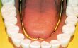 Betaalbare Dental Implant Procedures