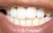 Voedingsmiddelen te vermijden na Teeth Whitening