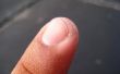 How to Spot van verschillende soorten schimmel van de nagel