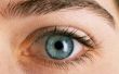 Tekenen & symptomen van gordelroos in het oog