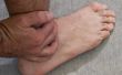 Hoe te behandelen een gezwollen voet van een insectenbeet