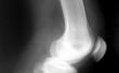 Verlichting van artritis knie pijn