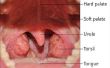 Over volwassen tonsillectomie