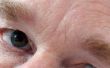 How to Get Rid van ingevallen ogen & cirkels