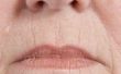 Een niet - Procedure kunnen verzachten van Lip rimpels