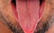 Hoe te genezen zweren van de tong