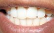 Profs & tegens van tandheelkundige verzekering
