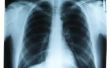 Projecten van de wetenschap op de longen