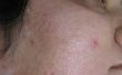 Hoe de behandeling van acnelittekens