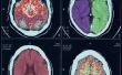 Tekenen & symptomen van een gebrek aan zuurstof naar de hersenen