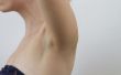 How to Get Rid van onderarm hobbels