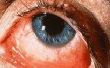 Chlamydia oog infectie symptomen