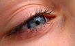 How to Spot ogen symptomen van hoge bloeddruk