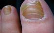 Een nagel schimmel behandeling met Vicks