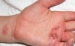 Hoe te behandelen Stafylokok huidinfecties