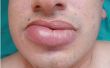 Behandeling van gezwollen lippen