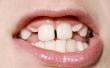 Opties voor positiebepaling vol tanden