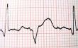 Hoe de berekening van de hartslag op een EKG