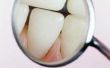Hoe te verwijderen van verharde tandplak tussen de tanden