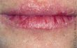 Wat oorzaken gebarsten lippen splitsen?