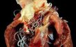Menselijke hartworm ziekte