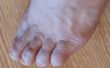 Hoe te verwijderen van de voet likdoorns