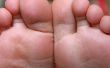 Hoe maak je je eigen diabetische voet-Lotion