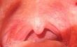 Huis remedie voor congestie van het slijm in de keel