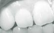 Problemen met tanden fineer