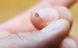 How to Get Rid van gemeenschappelijke wratten onder de nagels