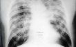 Wat Is longfibrose?