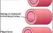 Hoe lager uw LDL Cholesterol natuurlijk