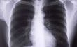 Hoe weet u of u hebt Bronchitis