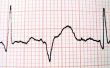 Het verschil tussen een EKG & een Echocardiogram