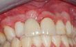 Over mislukte tandheelkundige implantaten