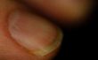Genezing van een gespleten nagel