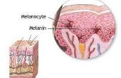 Wat zijn de gevaren van melanoom huidkanker?