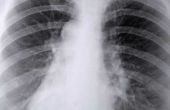 De levensduur van tuberculose druppels