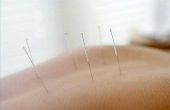 Het beheren van Tinnitus met acupunctuur
