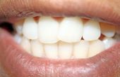 Voedingsmiddelen te vermijden na Teeth Whitening