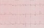 Hoe lees ik een EKG-Strip