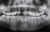 Soorten tandheelkundige Partials