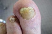 Hoe te identificeren van nagel schimmel