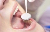 Bouw van de metalen Coping in keramiek in de tandheelkunde