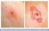 Symptomen van een MRSA Staph Infection