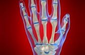 Eerste symptomen van artritis in handen
