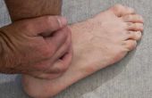 Hoe te behandelen een gezwollen voet van een insectenbeet