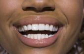 Doe het zelf mondstuk Molding voor Teeth Whitening