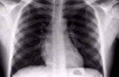 Wat doet een Smoker's X-Ray Look Like?