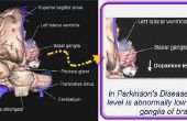 Wat Is de prognose voor de ziekte van Parkinson?